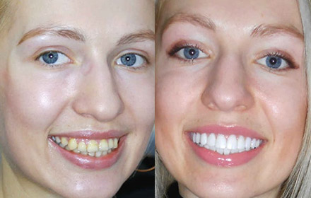 Snap-On-Smile