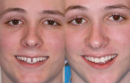 Snap-On-Smile