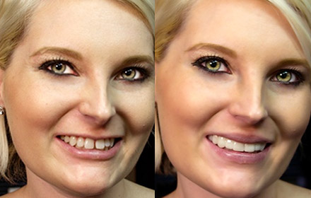 Snap-On-Smile