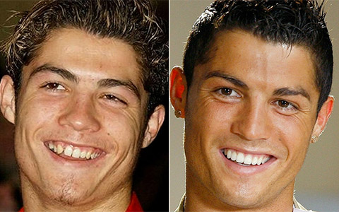 Snap-On-Smile